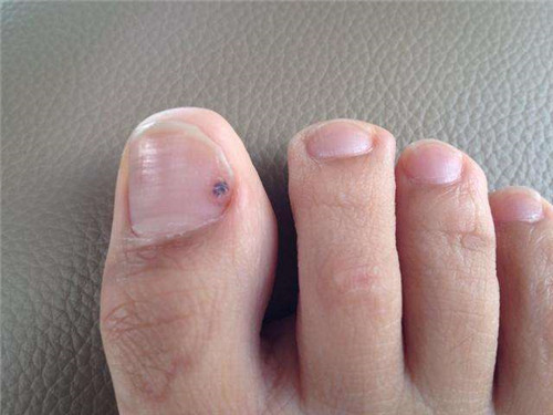 临床实验研究发现,在门诊中大约16%的黑色素瘤患者的患处都是在指甲