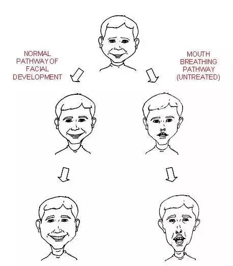 许多具有所谓的"腺样体面容"的人也并不存在口呼吸.