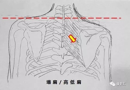 这种疼痛通常表现为酸痛,常见的位置大多在沿肩胛骨内侧缘靠下的位置