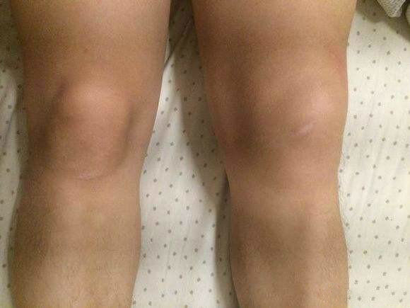 膝关节积液如何运动:膝关节积液,有什么运动可以帮助恢复?