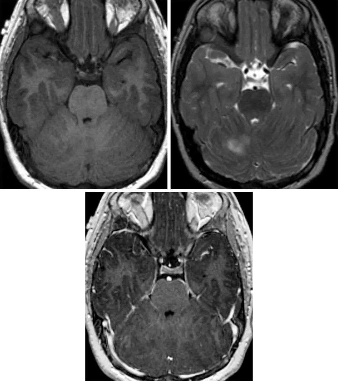 小脑发育不良性节细胞瘤的影像学特征 | the neurosurgical atlas全文