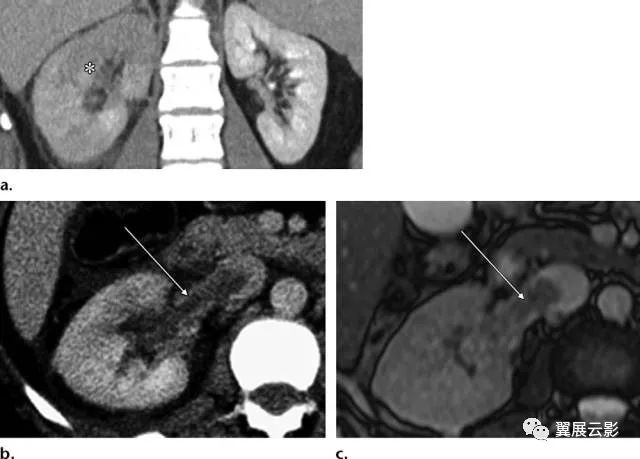 收藏23种肾血管病变的影像学表现汇总