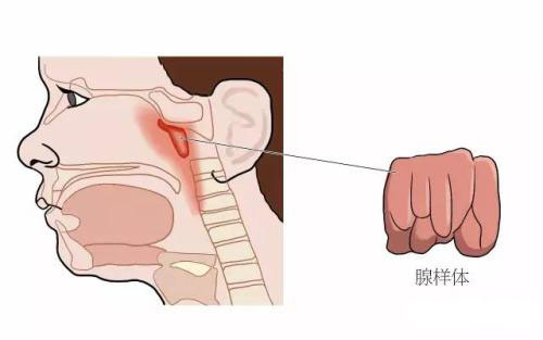 石萍切除腺样体是否会影响儿童免疫力