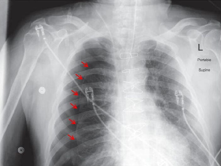 立即完善床旁胸片,提示右侧大量气胸(图2).