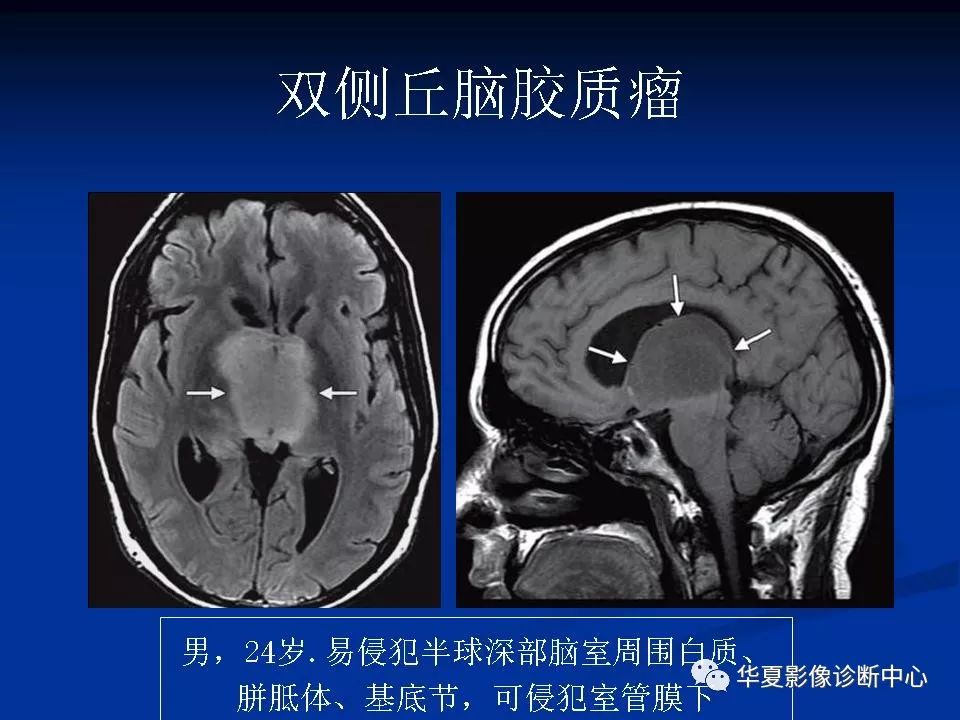 双侧丘脑对称性病变的影像诊断