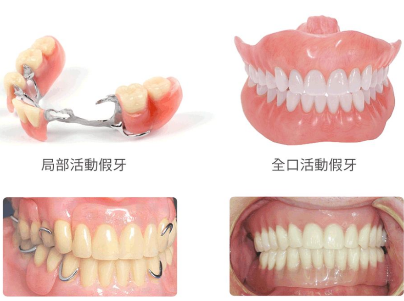 假牙分四种,你用的是哪一种?