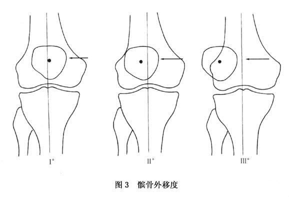 髌骨脱位就是髌骨失去了正常的位置,一般分脱位和半脱位.
