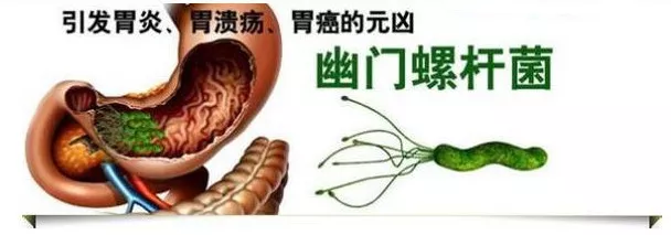 幽门螺杆菌或幽门螺旋菌,英文名helicobacterpylori,简称hp.