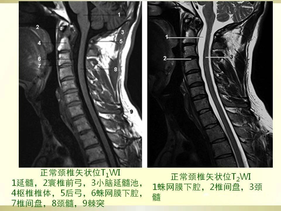 颈椎病的影像学诊断及分型汇总