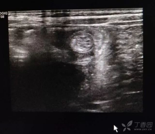 影像资料如下:辅助检查:腹部彩超显示中上腹腔同心圆征(肠套叠,考虑