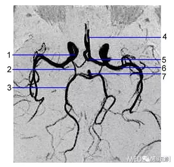 大脑后动脉;4.大脑前动脉;5.前交通动脉;6.大脑中动脉;7.基底动脉.