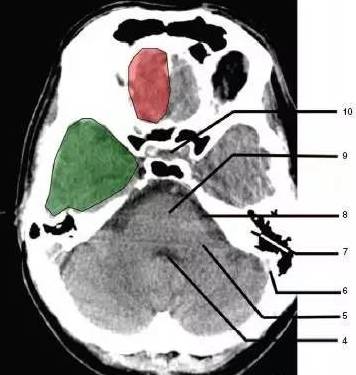 为额叶(frontal lobe)2,延髓 (medulla oblongata)1,蝶窦(sphenoid