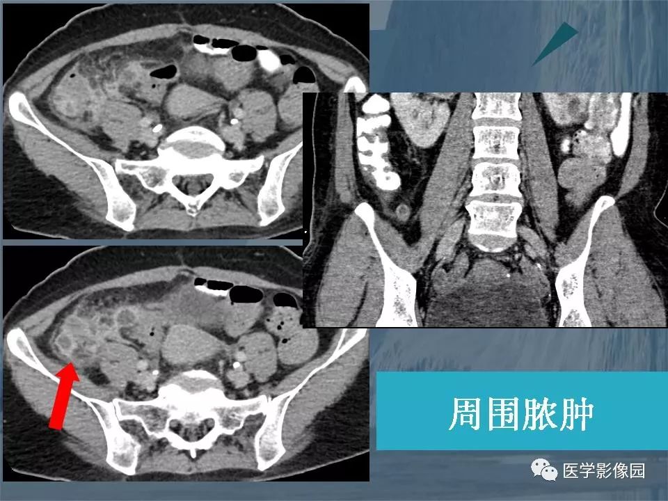 急性阑尾炎的鉴别诊断:阑尾炎的ct诊断