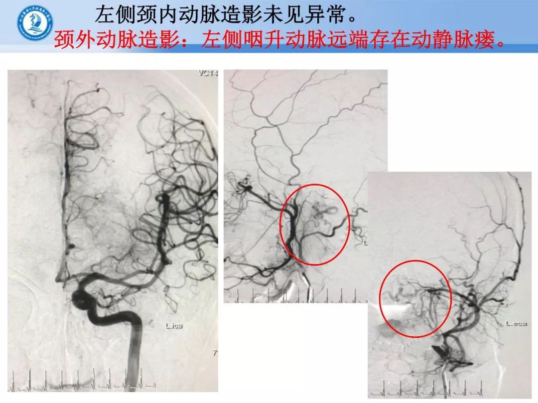 【正海-妙术视界】| 宋飞教授:颅颈交界区硬脑膜动静脉瘘夹闭一例