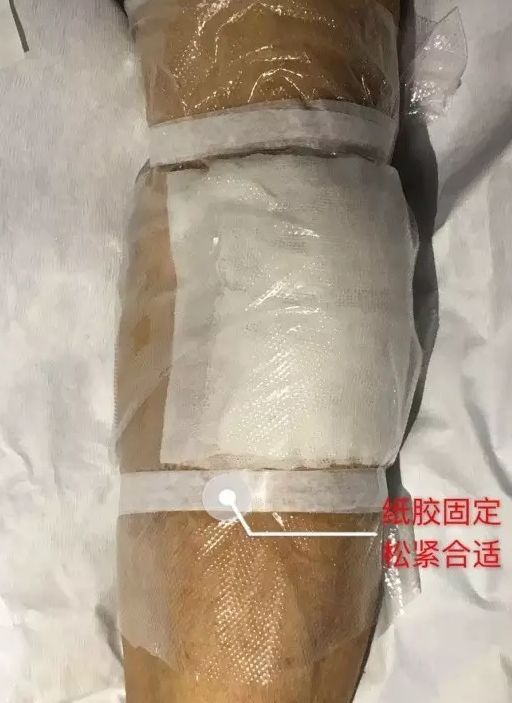 硫酸镁湿敷越敷越肿,静脉炎还能如何处理