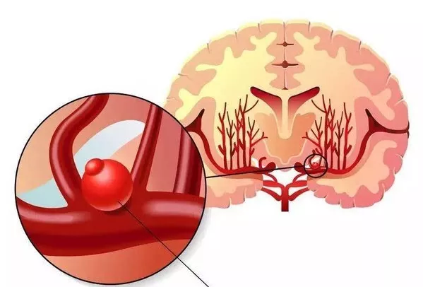 颅内动脉瘤破裂出血是脑卒中发生中最危险的一类.