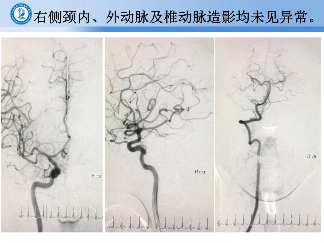 【正海-妙术视界】| 宋飞教授:颅颈交界区硬脑膜动静脉瘘夹闭一例