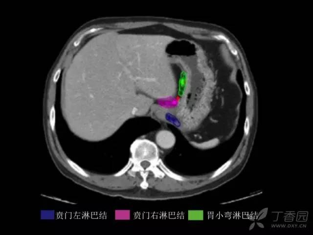 实用图谱帮你搞清胃癌淋巴引流区分布