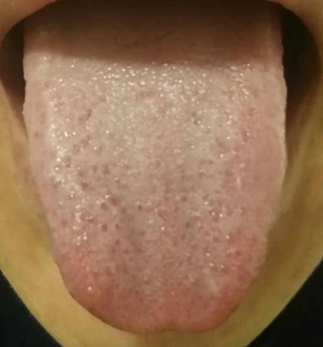 舌苔白腻怎么办