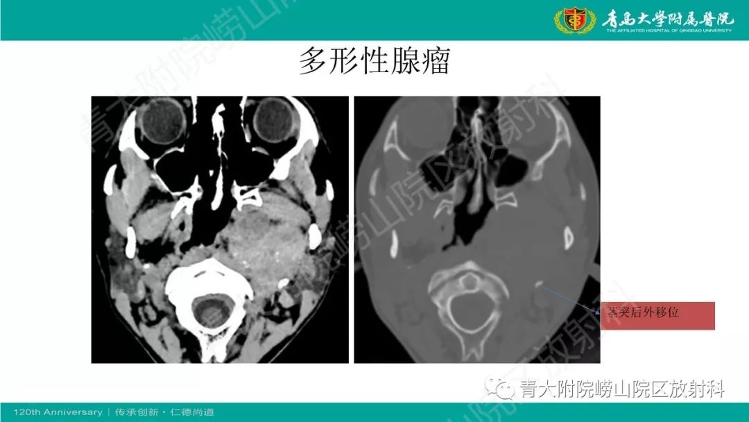 【每日一例 593例】女,左侧颌下肿物2年余