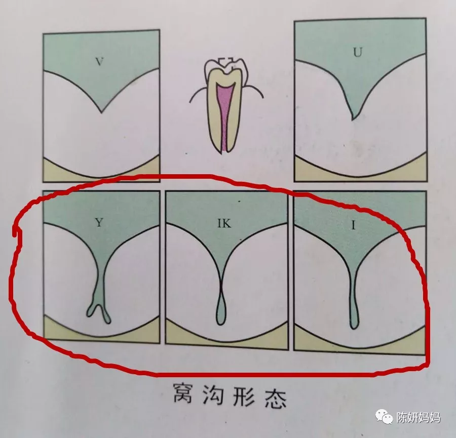 (下面这种形态的牙齿窝沟更容易蛀牙)