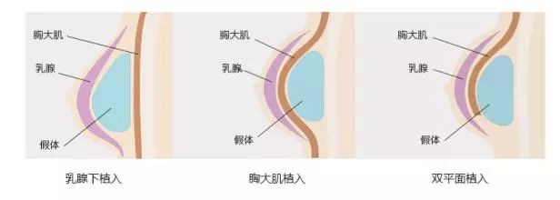 圆形假体也被称为维纳斯型,能将乳房下垂和凹陷撑起来,整体看起来比较