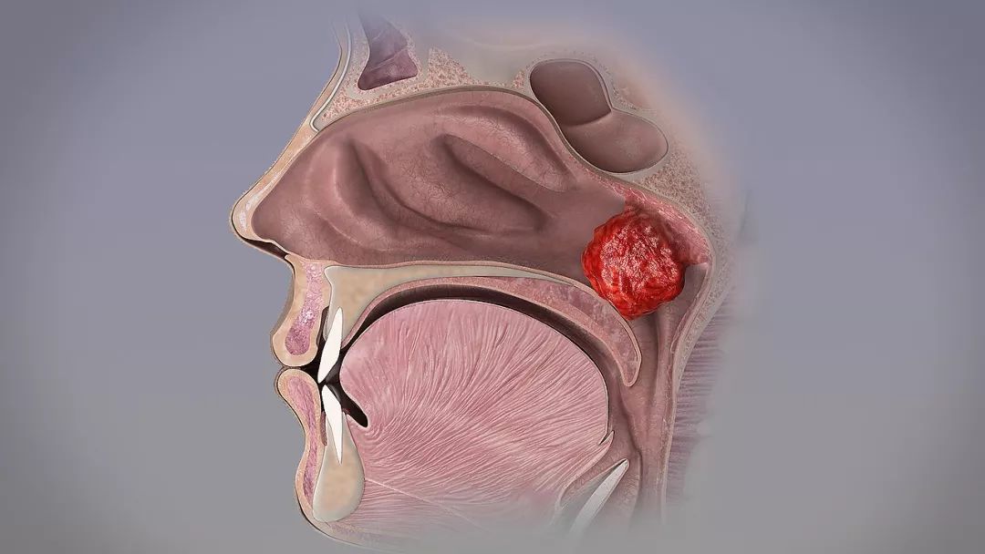 球大小的腺样体阻塞鼻腔通道