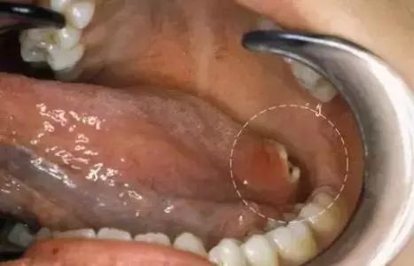 这种口腔溃疡一定要在意,女子三周后被确诊为舌癌!
