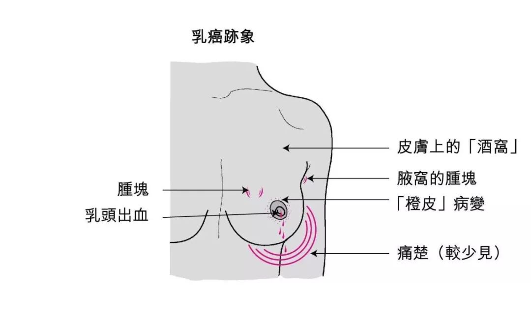 20岁女子患乳腺癌,生活中远离这些不良习惯