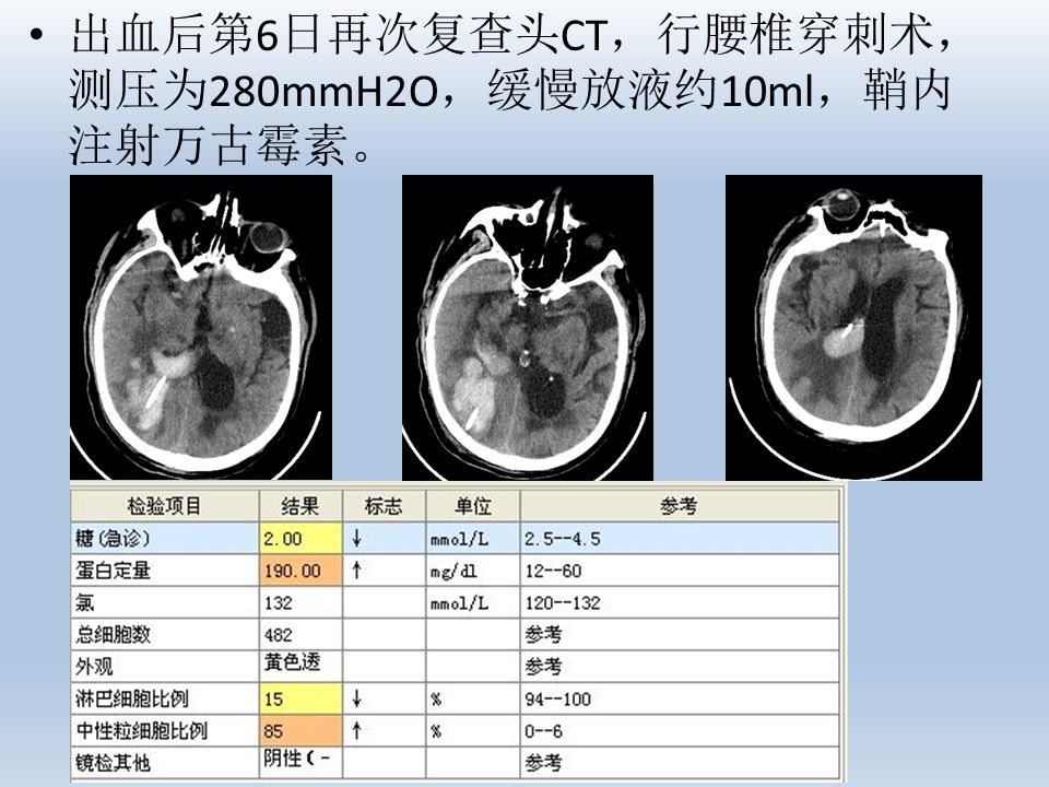 二例脑室-腹腔分流术后迟发分流管周围血肿形成的病例