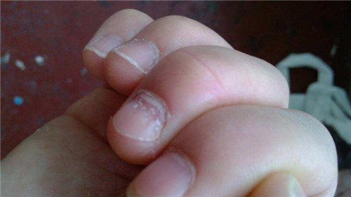 一般缺钙的指甲上会出现凹痕.如何知道自己缺乏它呢?