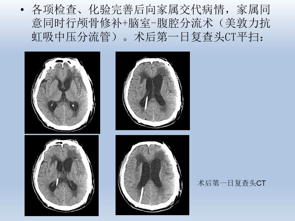 二例脑室-腹腔分流术后迟发分流管周围血肿形成的病例