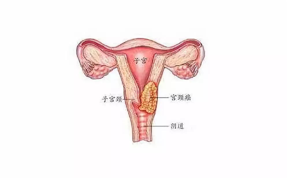 90%以上的宫颈癌伴有高危型hpv感染