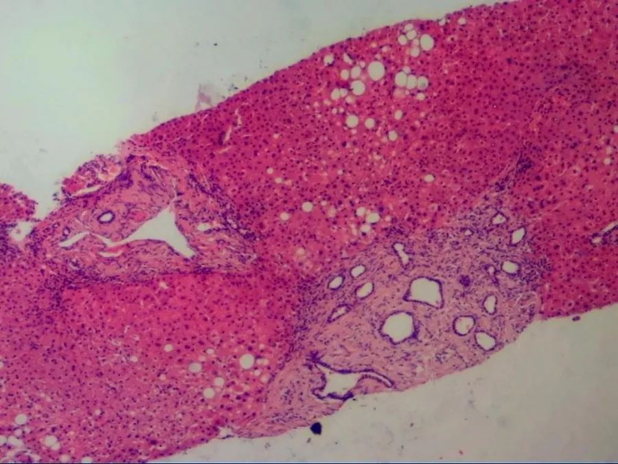 20余年来患者反复出现肝功能异常,曾多次至我院及外院就诊,但肝功能