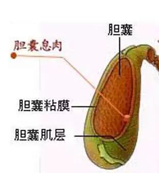 新技术丨保胆 微创无痕,胃镜下消灭"恼人"的胆囊息肉!