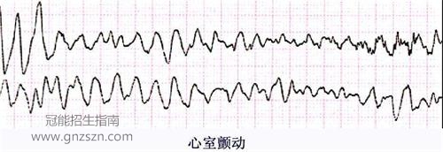 心室扑动与心室颤 