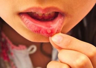 疱疹样口腔溃疡的发病率相对比较低,在临床上也是非常少见的.
