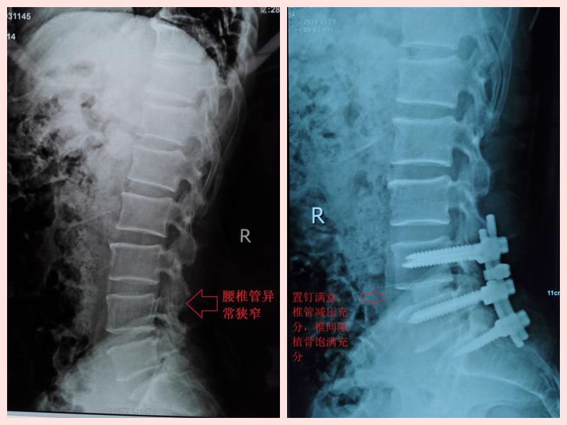 医疗|患者反复腰痛苦不堪言 医院腰椎手术立竿见影