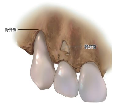 骨开裂是牙龈退缩的必要条件