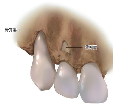 发生牙龈退缩的过程,常与两种解剖结构有关—边缘龈和颊侧牙槽骨.