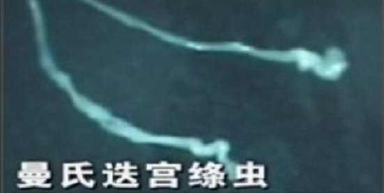 小知识: 1,曼氏迭宫绦虫