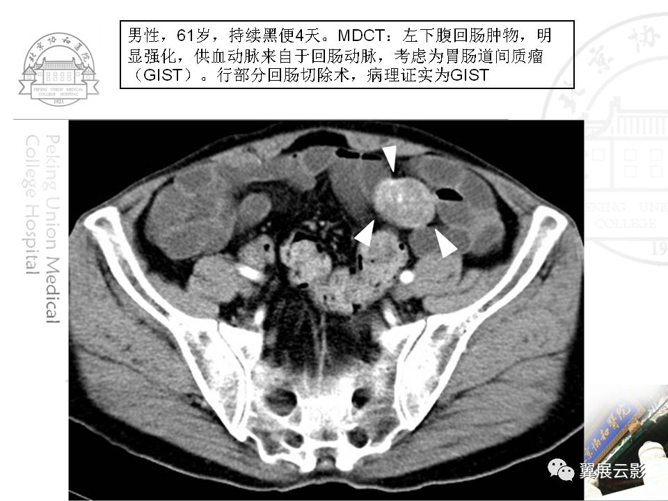 多排螺旋ct对消化道出血临床诊治流程的指导意义