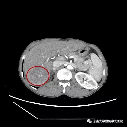 通过ct影像可以看出,肝癌病灶部位通过磁共振影像可见,术后致密碘油