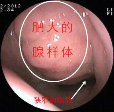 医生有你:腺样体肥大是什么原因引起的?