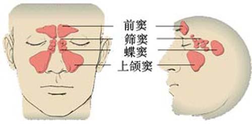 上颌窦,筛窦,额窦和蝶窦的粘膜发炎统称为鼻窦炎.
