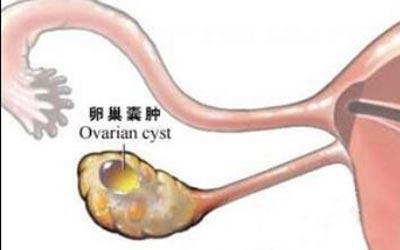 清巢定宫散:什么是卵巢囊肿?形成因素有哪些?