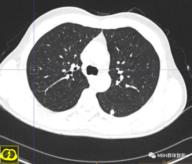肺癌早期ct影像标注助力"ai 医疗"
