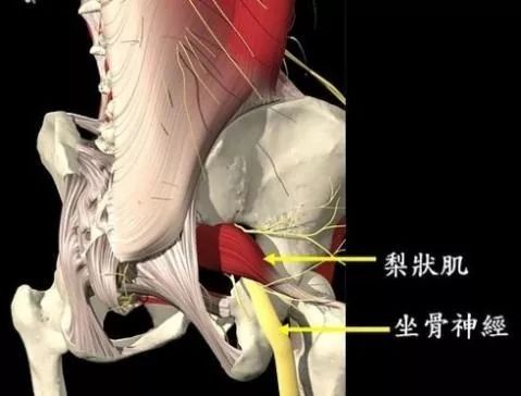 梨状肌损伤综合症:梨状肌损伤综合症的运动康复