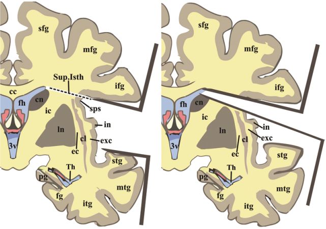 神外专题大脑峡部的纤维束解剖