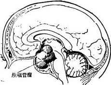 国内首例经鼻内窥镜下儿童颅咽管瘤切除手术成功